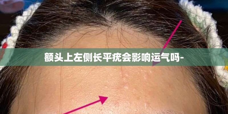 额头上左侧长平疣会影响运气吗-